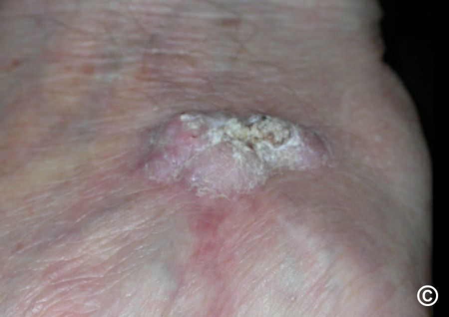 late squamous cell carcinoma