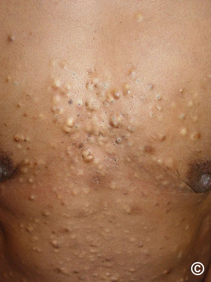 Steatocystoma multiplex
