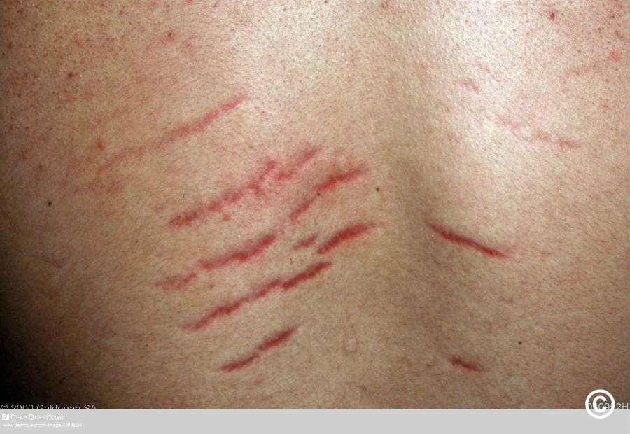 Striae - stretch marks