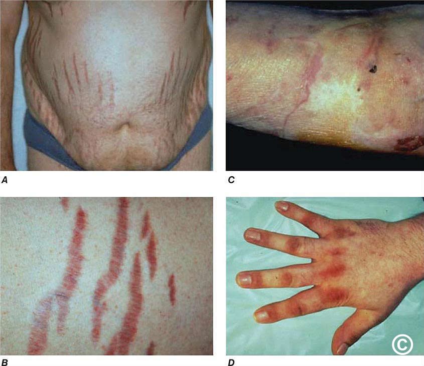 Stretch Marks Men Groin