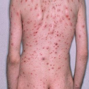 Syphilis