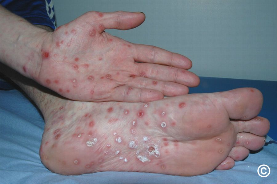 Syphilis