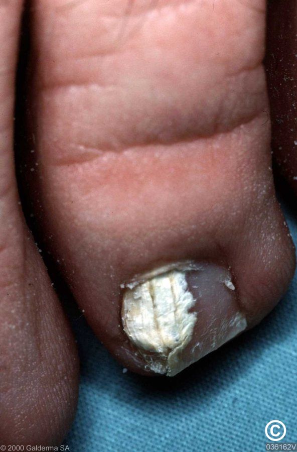 What you need to know about pseudomonas nail infections aka 
