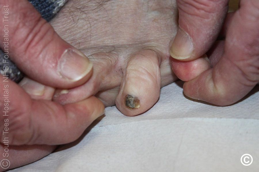 Nail Fungus Infection on the Big Finger. Fungal Infection on Nails Hand,  Finger with Onychomycosis.Closeup Stock Image - Image of sores, medicine:  219257625