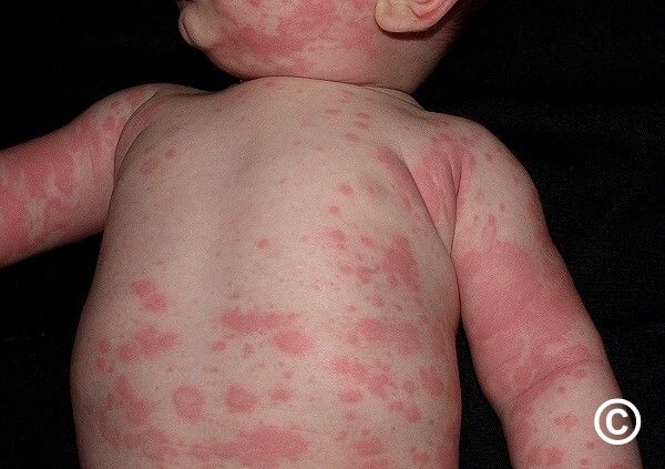 Acute urticaria