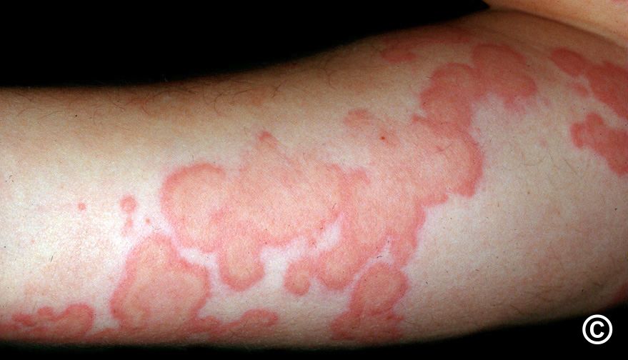 Urticarial vasculitis