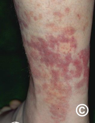Urticarial vasculitis