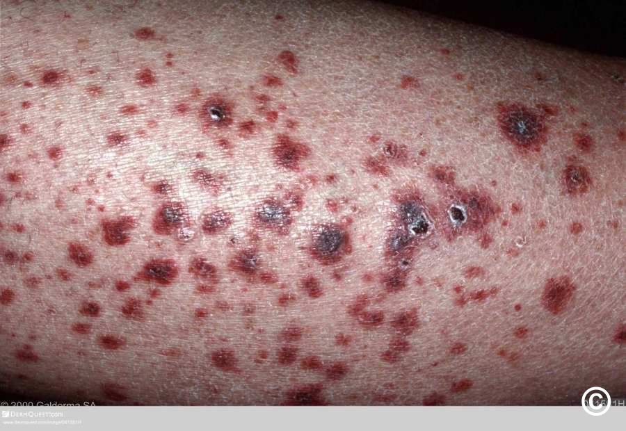 Cutaneous small vessel vasculitis