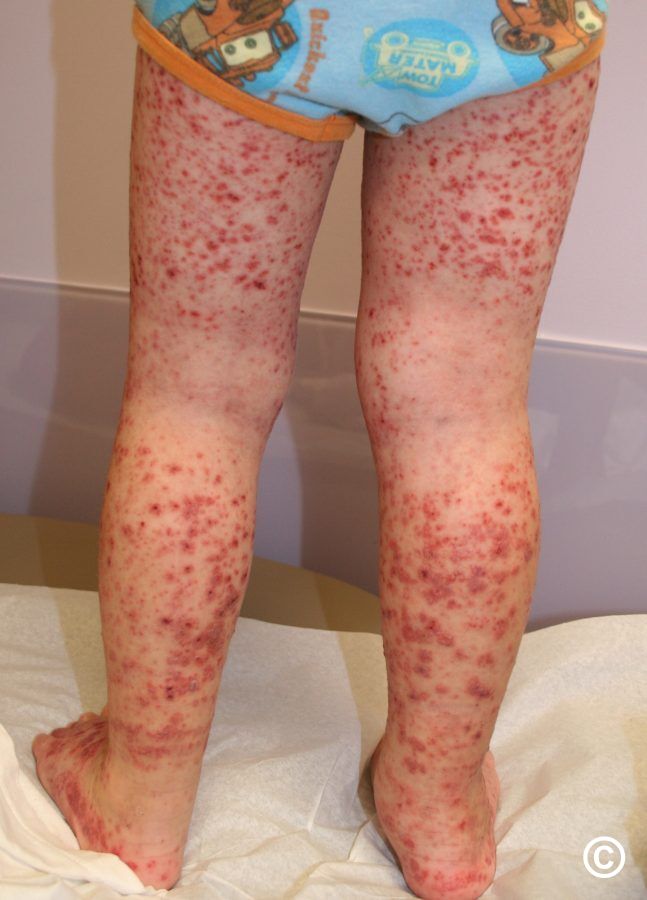 Vasculitis