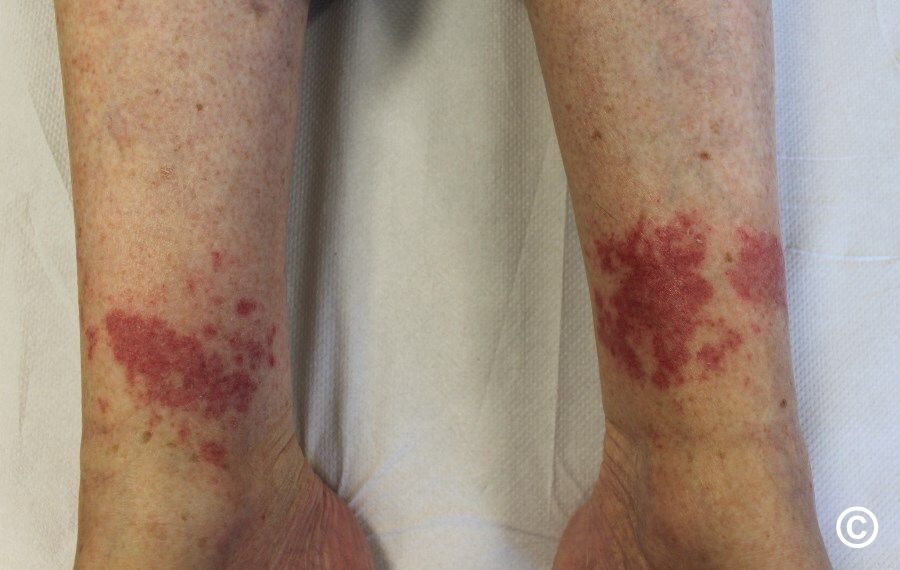 Exerciseinduced vasculitis