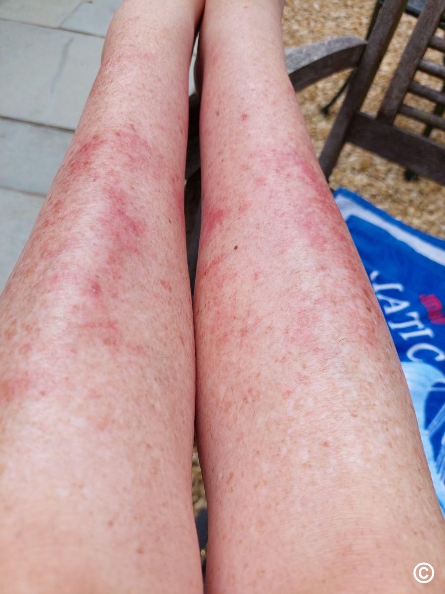 Exercise Induced Capillaritis