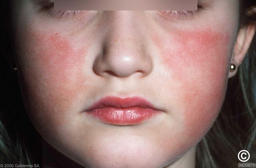 Erythema infectiosum (syn. fifth disease; slapped cheek syndrome)