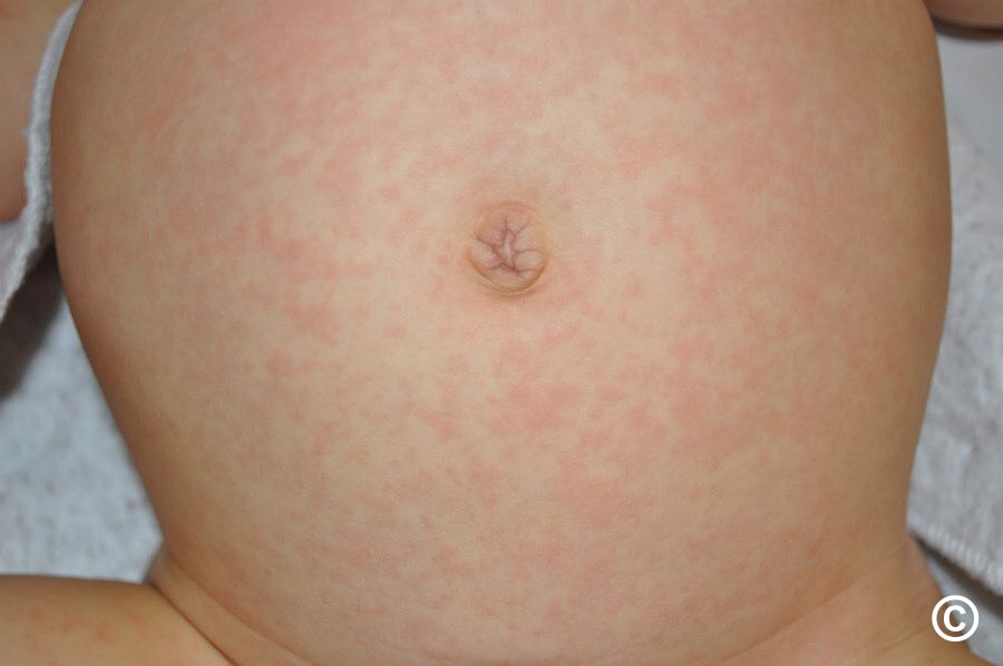 Erythema subitum
