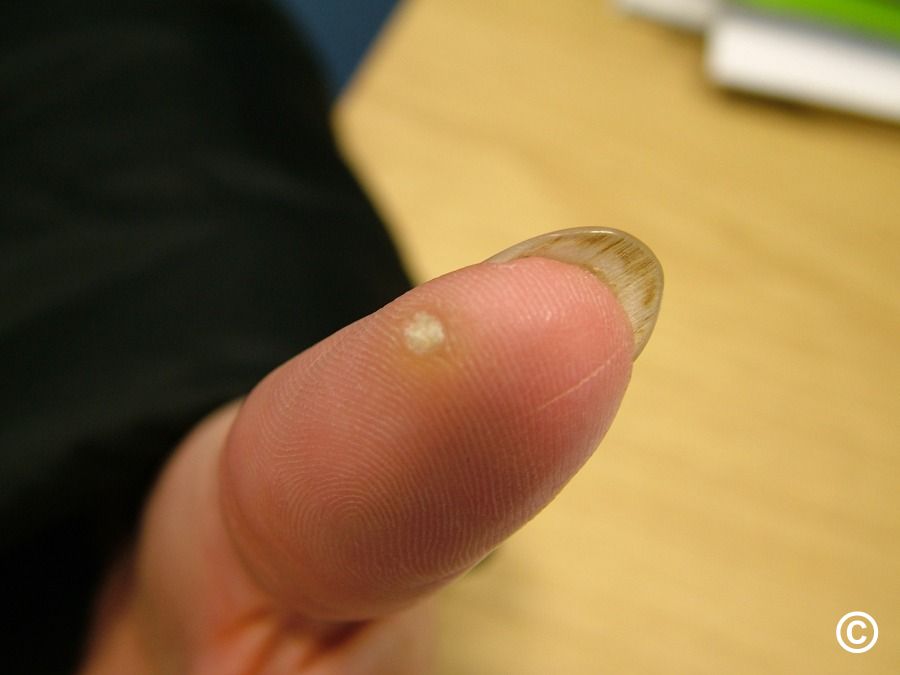 Flat Warts On Palm