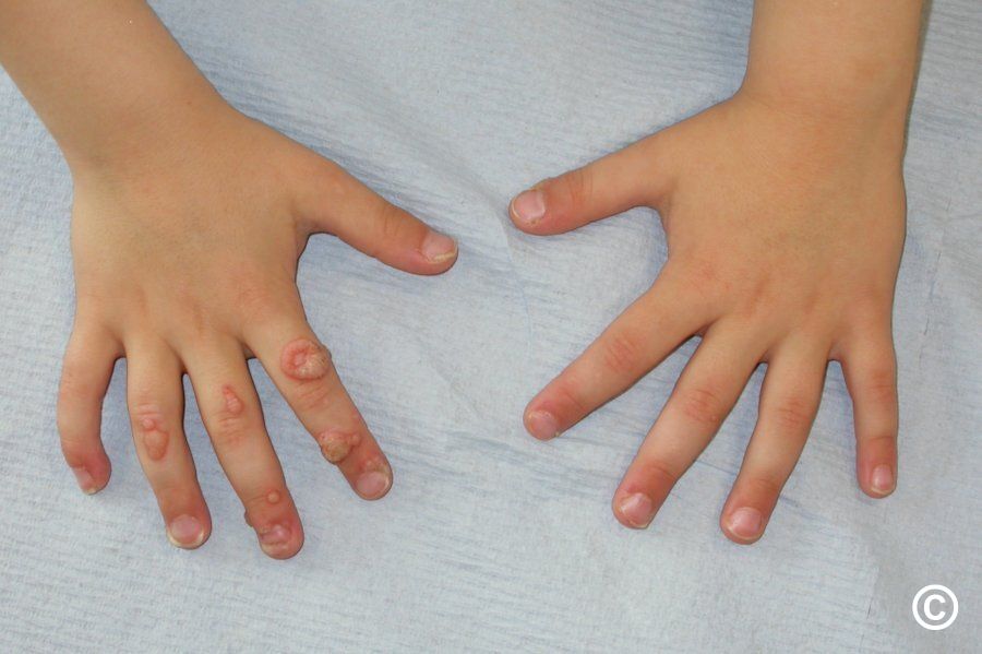 Warts