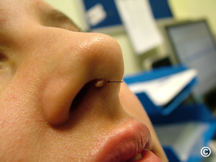 nasal viral papilloma
