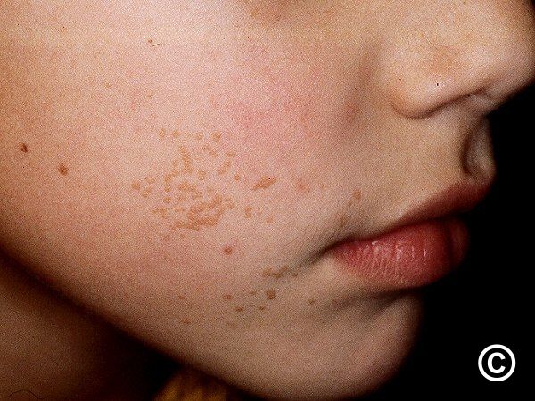 Warts Interracial 600x450 Sex Pic Hd Warts pic picture