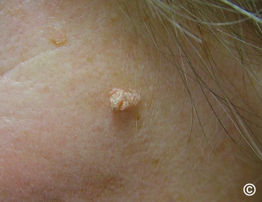 wart on scalp