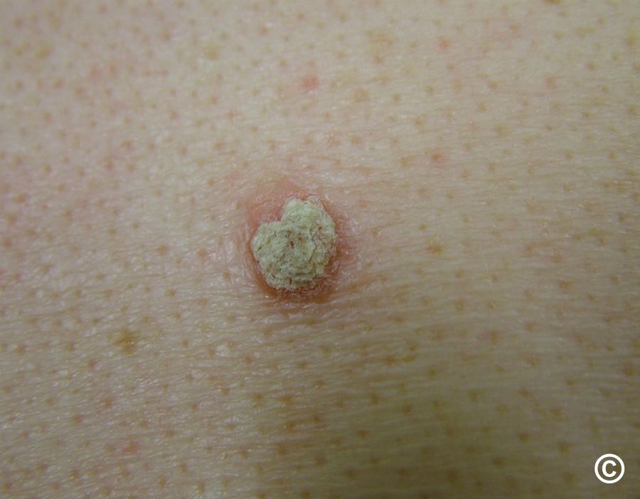 Actinic Keratosis Solar Keratosis Actinic Keratosis Solar Keratosis